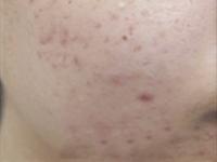 acne-treatment-townsville-qld