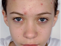 Acne Treatment Townsville